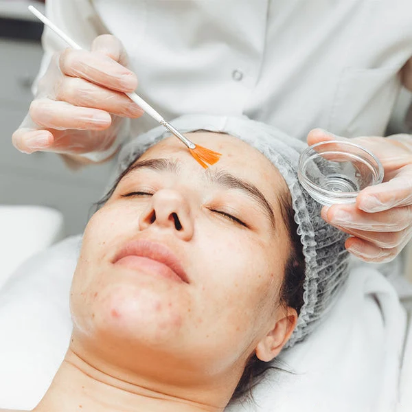VI Peel For ONLY $299 with any Neuromodulator Treatment