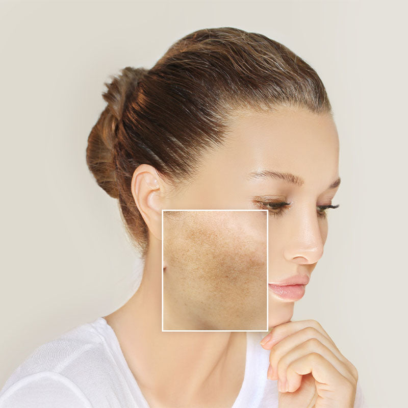 Hyperpigmentation/Melsma Cream