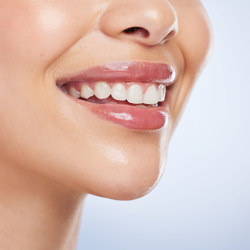 $10 OFF Teeth Whitening - Single Treatment